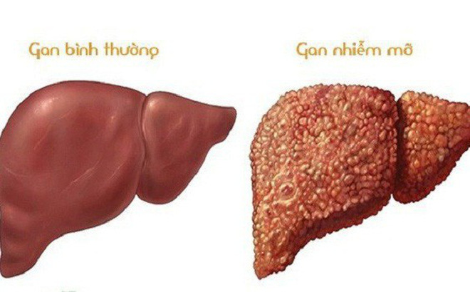 Gan nhiễm mỡ